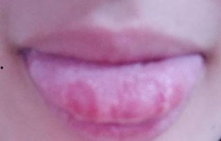 吃网纹瓜舌头刺痛,舌头刺痛揭秘背后的真相