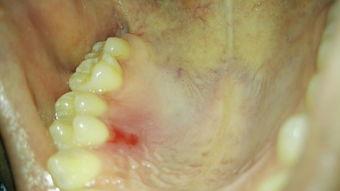 吃瓜上牙膛疼,揭秘口腔健康与饮食习惯的微妙关系